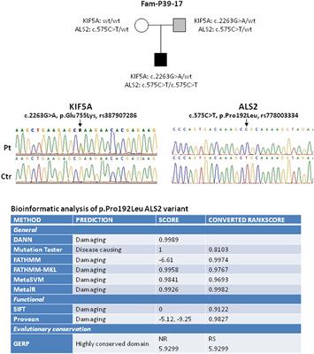 KIF5A and ALS2 Variants in a Family With Hereditary Spastic Paraplegia and Amyotrophic Lateral Sclerosis